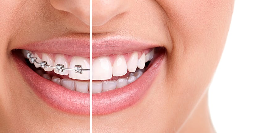 Eine Zahnspange im Erwachsenenalter – lohnt sich das?
